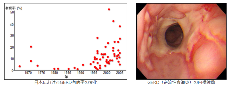 日本におけるGERD有病率の変化｜GERD（逆流性食道炎）の内視鏡像