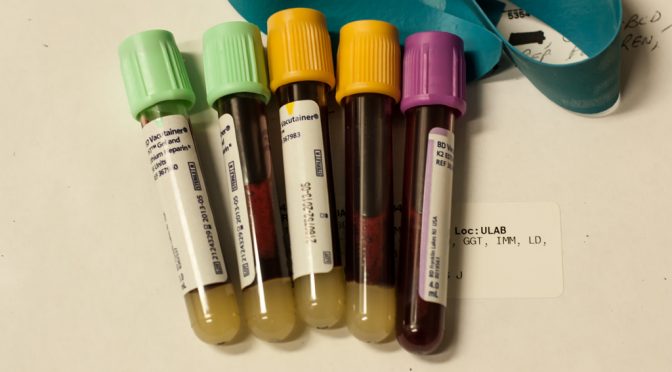 血液型がB型の人は貧血リスク低い｜遺伝子の個人差、血液検査に関連－46種を発見｜理研・東大