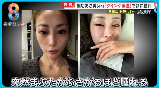 安住紳一郎アナの病気はクインケ浮腫！クインケ浮腫とはどんな病気？気を付けたい症状のサインとは？